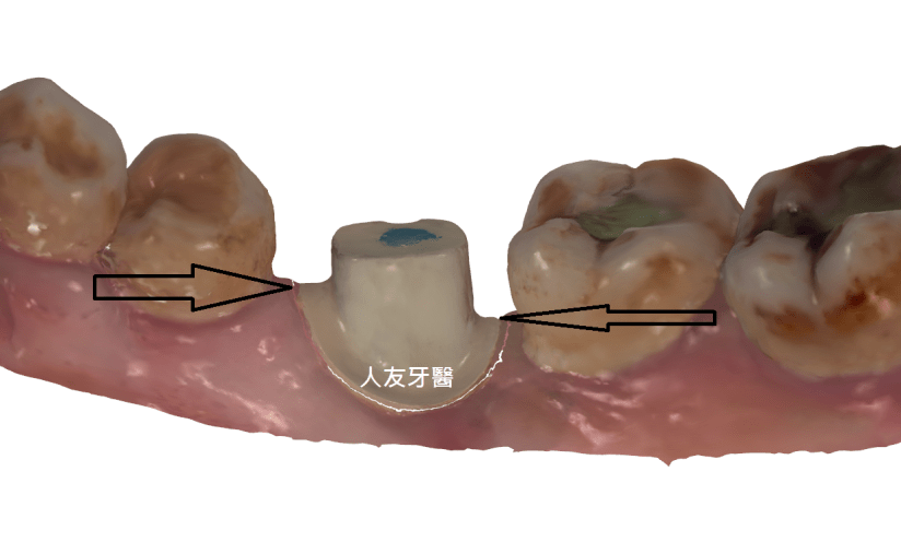 箭頭處為牙齦高度