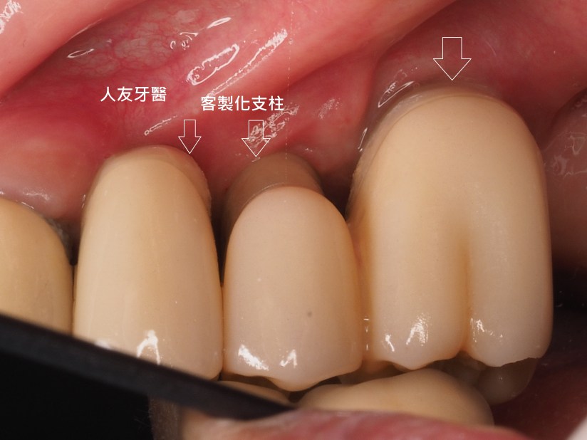 客制化氧化鋯不會露出金屬色