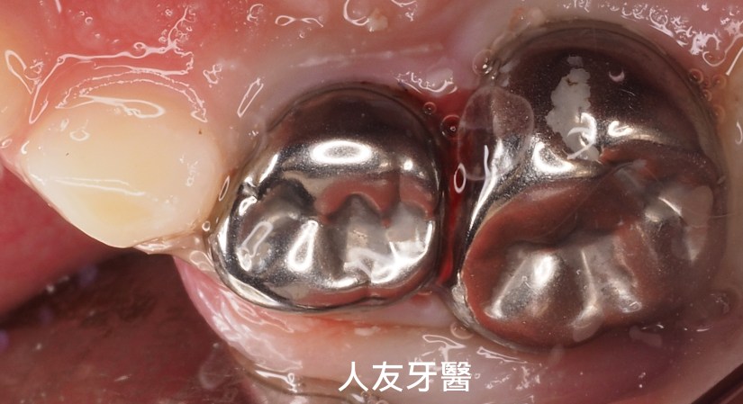 乳牙根管治療後套上乳牙牙套