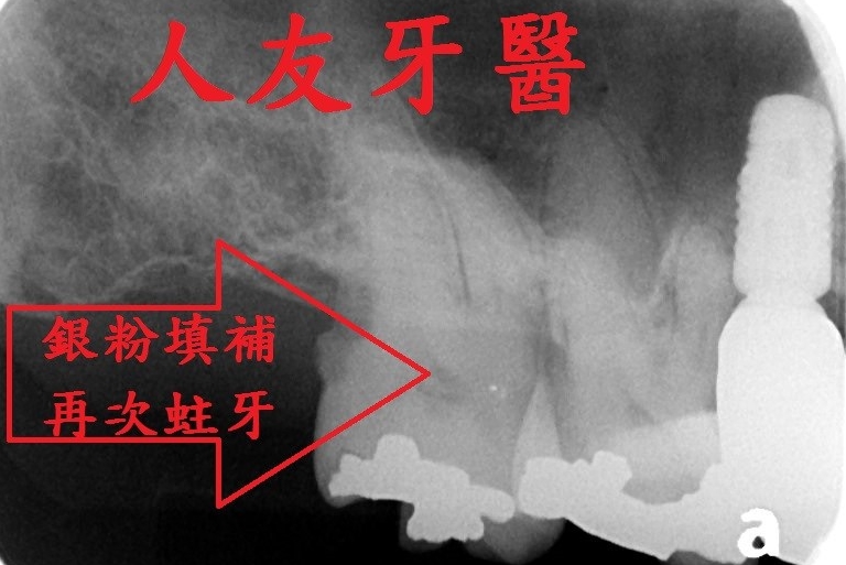 銀粉填補,牙裂跟蛀牙