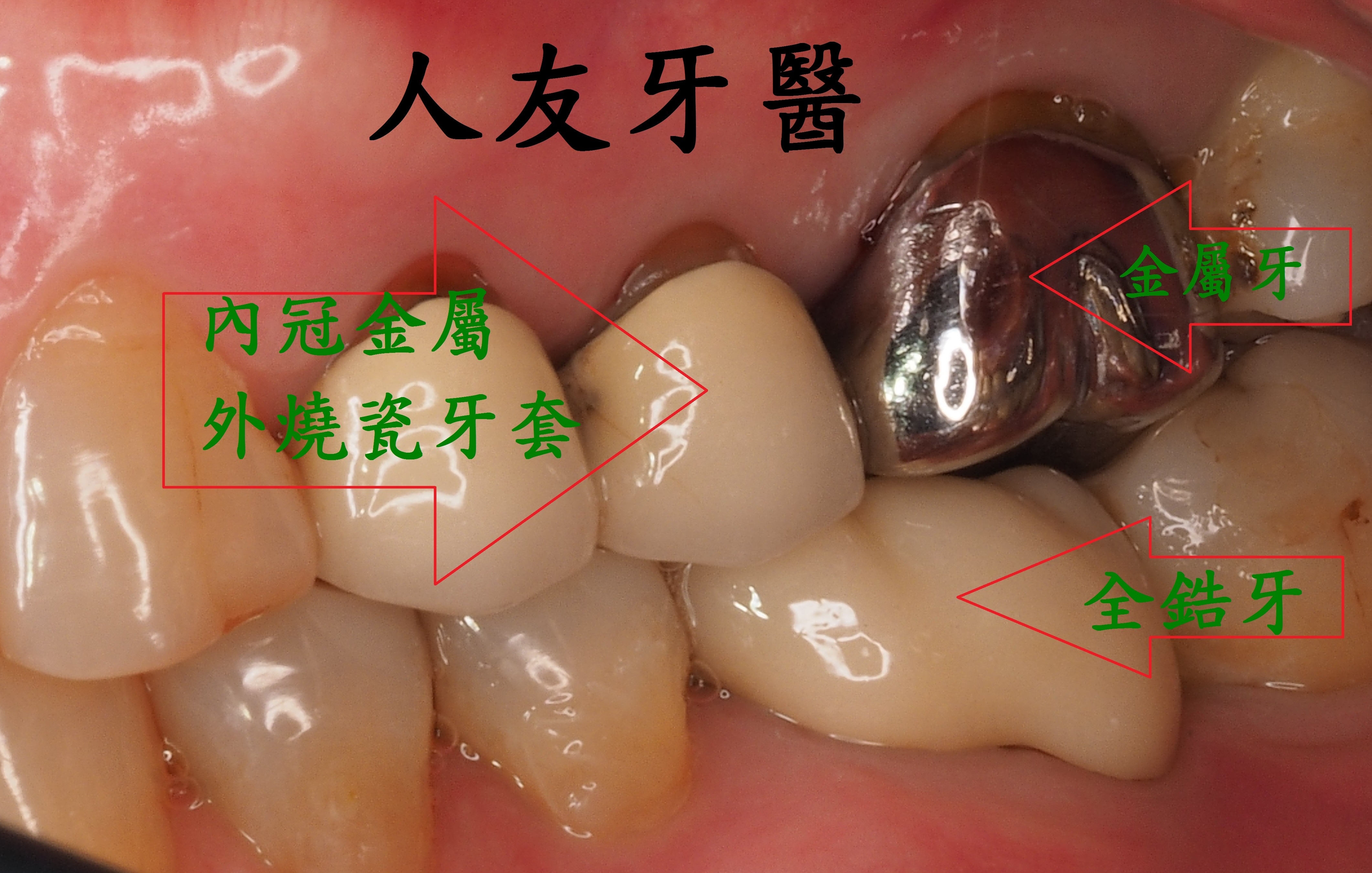 各種材質牙套比較