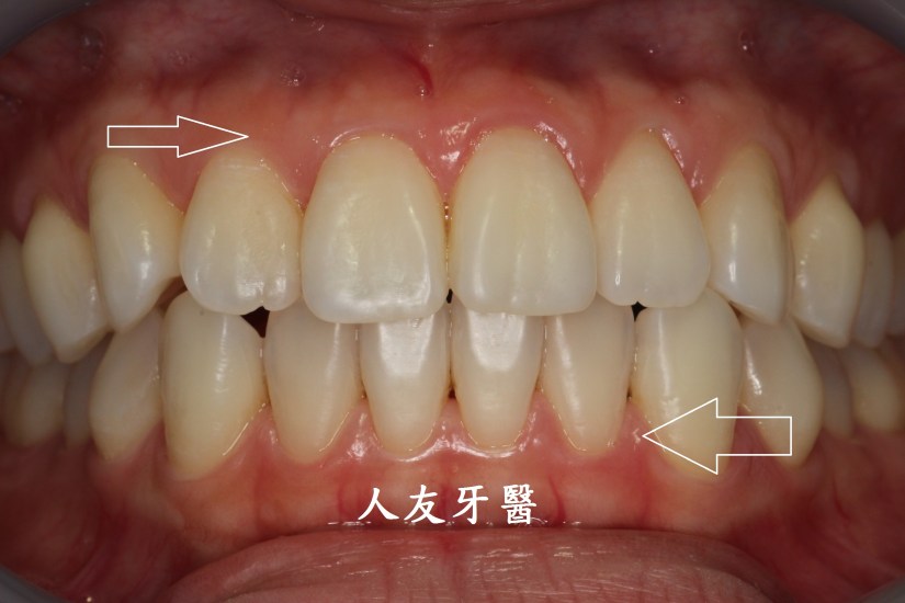 健康緊實的牙齦