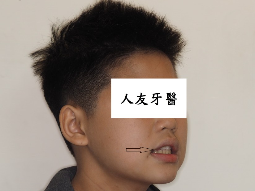 舌頭位置錯誤往前頂