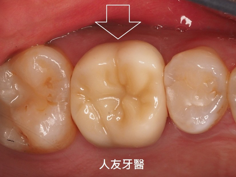 術後裝上全鋯牙冠